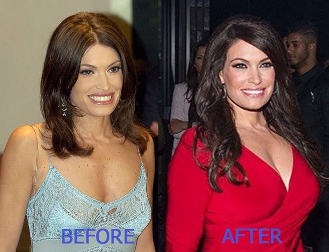 Kimberly Guilfoyle before and after plastic surgery.